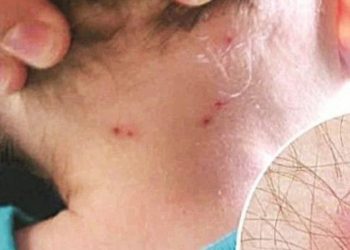 Reportan 12 casos sospechosos de rickettsia