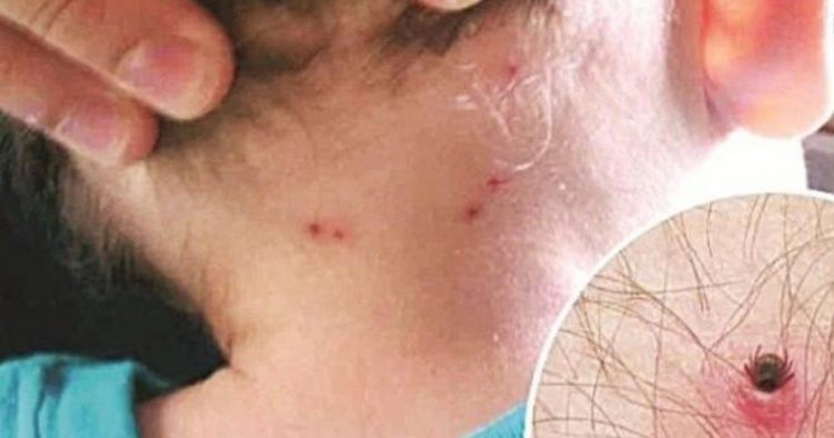 Reportan 12 casos sospechosos de rickettsia