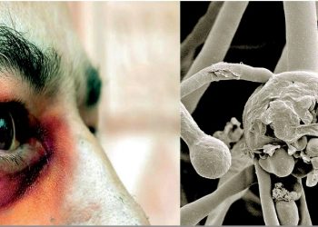 No hay aquí casos de hongo negro