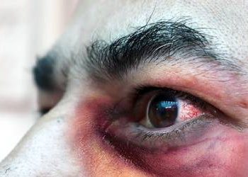 Hongo negro llega a Guerrero; detectan dos casos