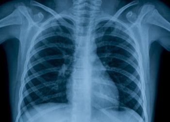 Secretaría de Salud registra 191 casos de tuberculosis