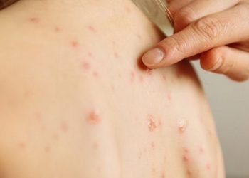 Temen aumente el sarampión en niños