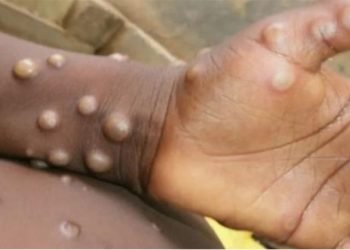 Estados Unidos confirma su primer caso de viruela de los monos en medio de un brote en Europa
