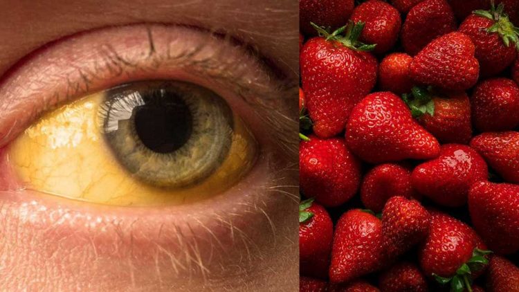 Confirman caso de Hepatitis A en un adulto