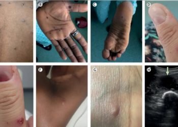 Viruela del mono llega a Japón; confirman el primer caso