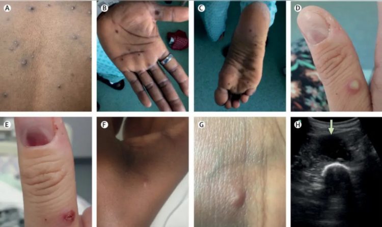 Viruela del mono llega a Japón; confirman el primer caso