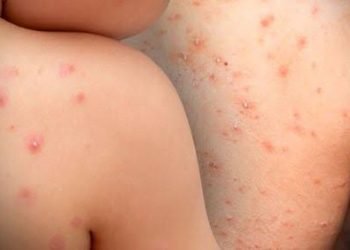 Se contagian niños de la viruela símica