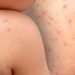 Se contagian niños de la viruela símica