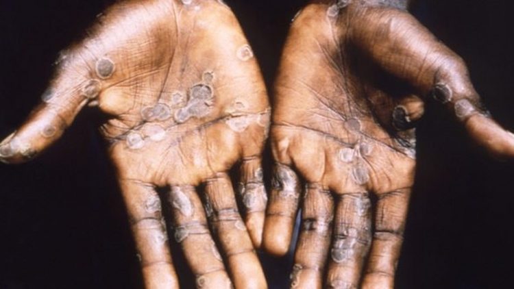 Declara OMS emergencia Global viruela símica