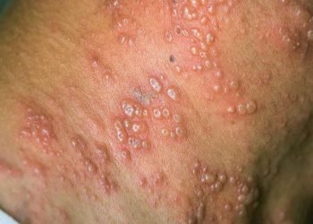 Suman 3 casos de viruela símica en Chiapas