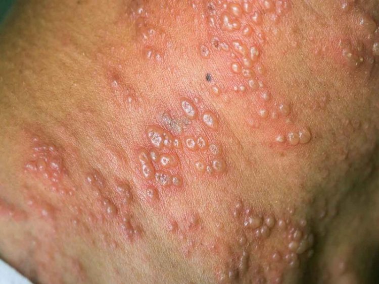 Suman 3 casos de viruela símica en Chiapas