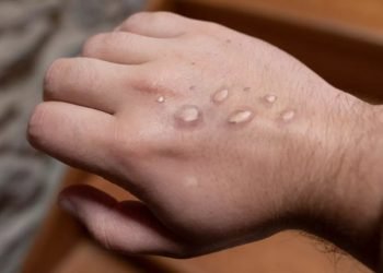 Laredo en alerta por la viruela del mono