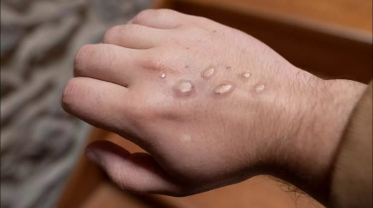 Surge en Laredo segundo caso de viruela del mono