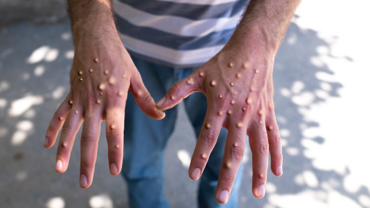 Suman ya tres casos de viruela del mono