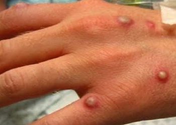 Laredo registra primer caso de viruela del mono