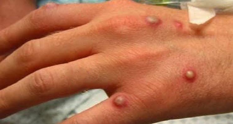 Laredo registra primer caso de viruela del mono