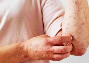 Avanza en México viruela del mono