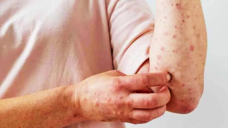 Avanza en México viruela del mono