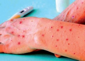 Sigue Salud sin aplicar medidas preventivas ante viruela símica