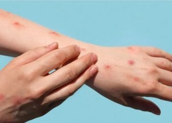 Dan seguimiento en Laredo a casos de viruela símica