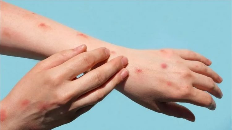 Dan seguimiento en Laredo a casos de viruela símica