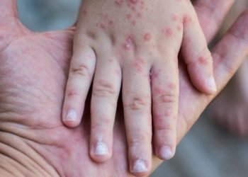 Tamaulipas continúa libre de casos de viruela símica