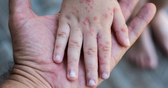 Tamaulipas continúa libre de casos de viruela símica