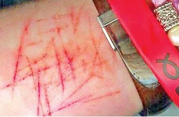 Reportan a Crede casos de alumnos con autolesiones