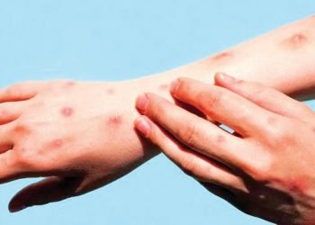 Acumula Tamaulipas 9 casos de viruela símica