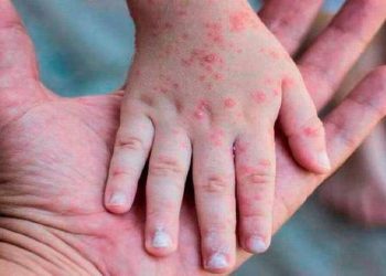 CDC: viruela símica no desaparecerá pronto