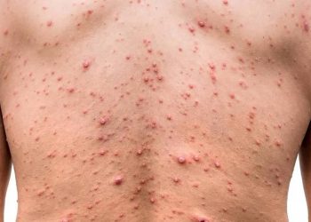 México suma tres mil siete casos confirmados de viruela del mono