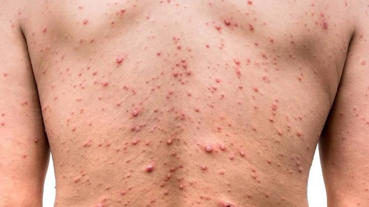 México suma tres mil siete casos confirmados de viruela del mono