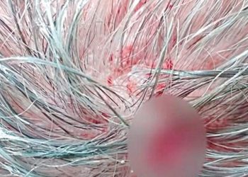 Laredense es herido en la cabeza por bala perdida