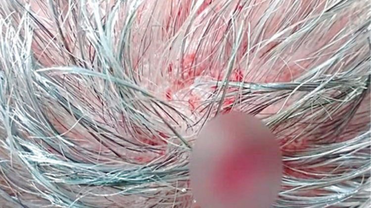 Laredense es herido en la cabeza por bala perdida