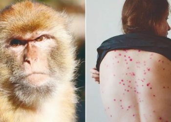 Hay 31 casos confirmados de Viruela de Mono en Tamaulipas