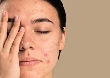 ¡Radiante y libre de acné! Descubre los secretos para prevenir y combatir este molesto problema