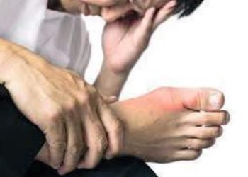 ‘Mal de gota’; enfermedad que la padecen más hombres que mujeres