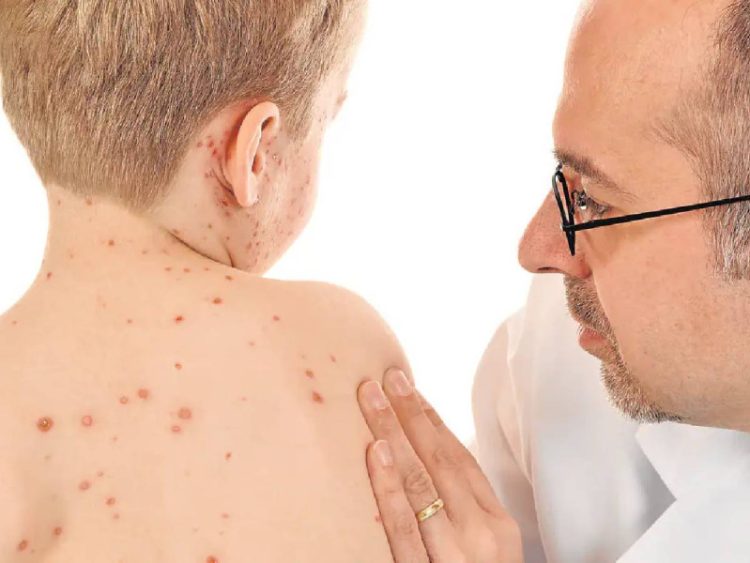 Aumento Alarmante de Casos de Sarampión Amenaza a Europa, Advierte la OMS