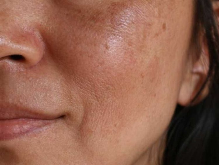 Consejos Sencillos para Evitar y Desvanecer Manchas en el Rostro