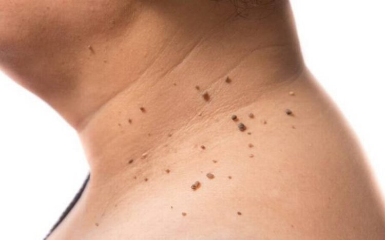 Cómo Eliminar Verrugas de la Piel de Forma Efectiva y Segura