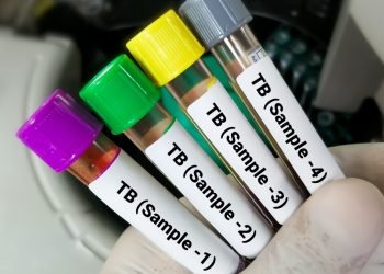 Miles en Texas no concluyen tratamiento contra tuberculosis