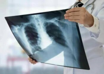 A la alza casos de tuberculosis