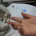 Pacientes con VIH SIDA llegan en fase terminal