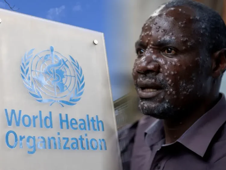 Declarada OMS Nueva Emergencia Mundial por Brote de Viruela del Mono