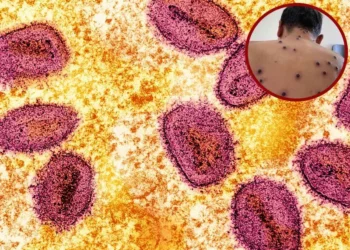 Casos de viruela del mono en México; uno en Tamaulipas