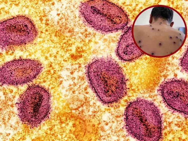 Casos de viruela del mono en México; uno en Tamaulipas