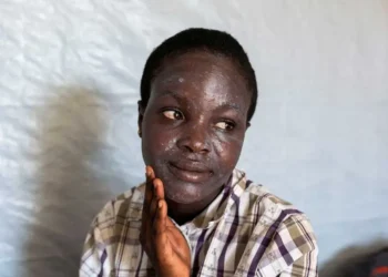 OMS: La Viruela del Mono «No es el Nuevo COVID, Sabemos Enfrentarlo»