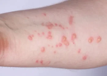 OMS lanza plan de 6 meses contra mpox con un costo de 135 millones de dólares