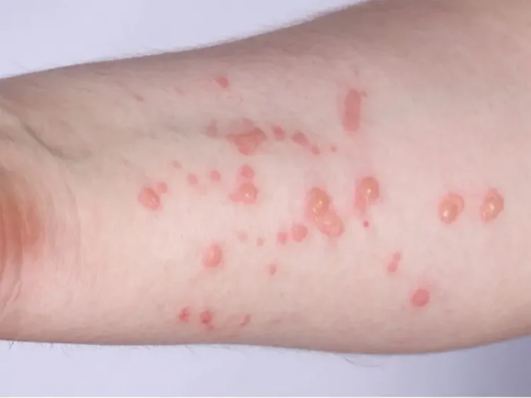 OMS lanza plan de 6 meses contra mpox con un costo de 135 millones de dólares