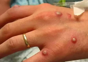 Alarma en Nayarit por paciente con viruela del mono que evade cuarentena